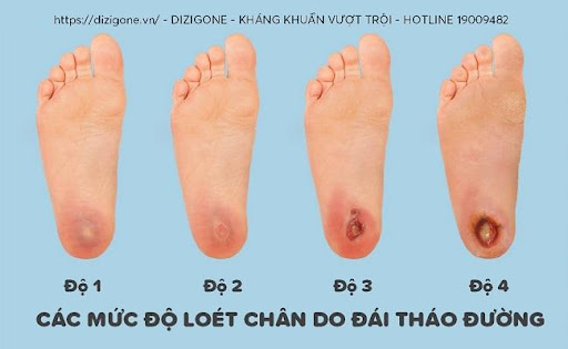 Các mức độ loét bàn chân do đái tháo đường
